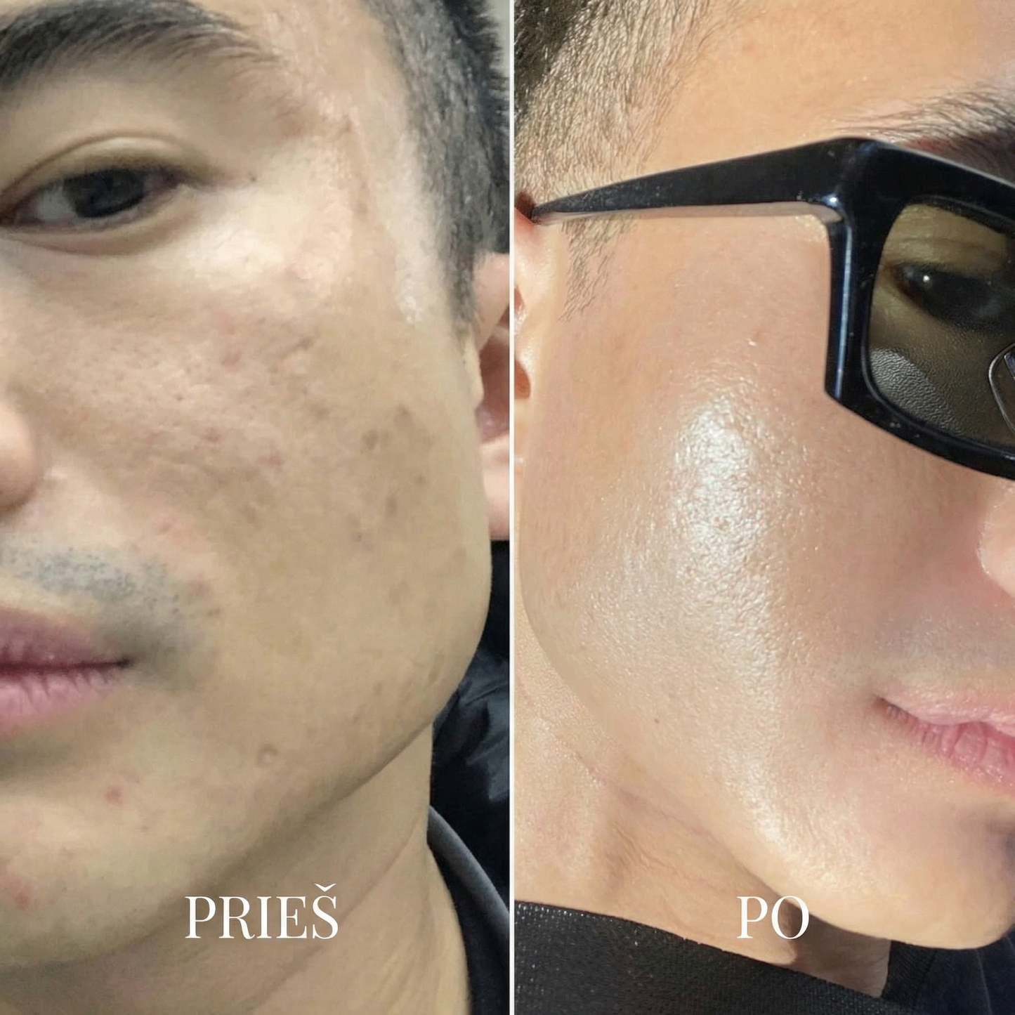 BLIME™ Inkštirų Valymo Įrenginys