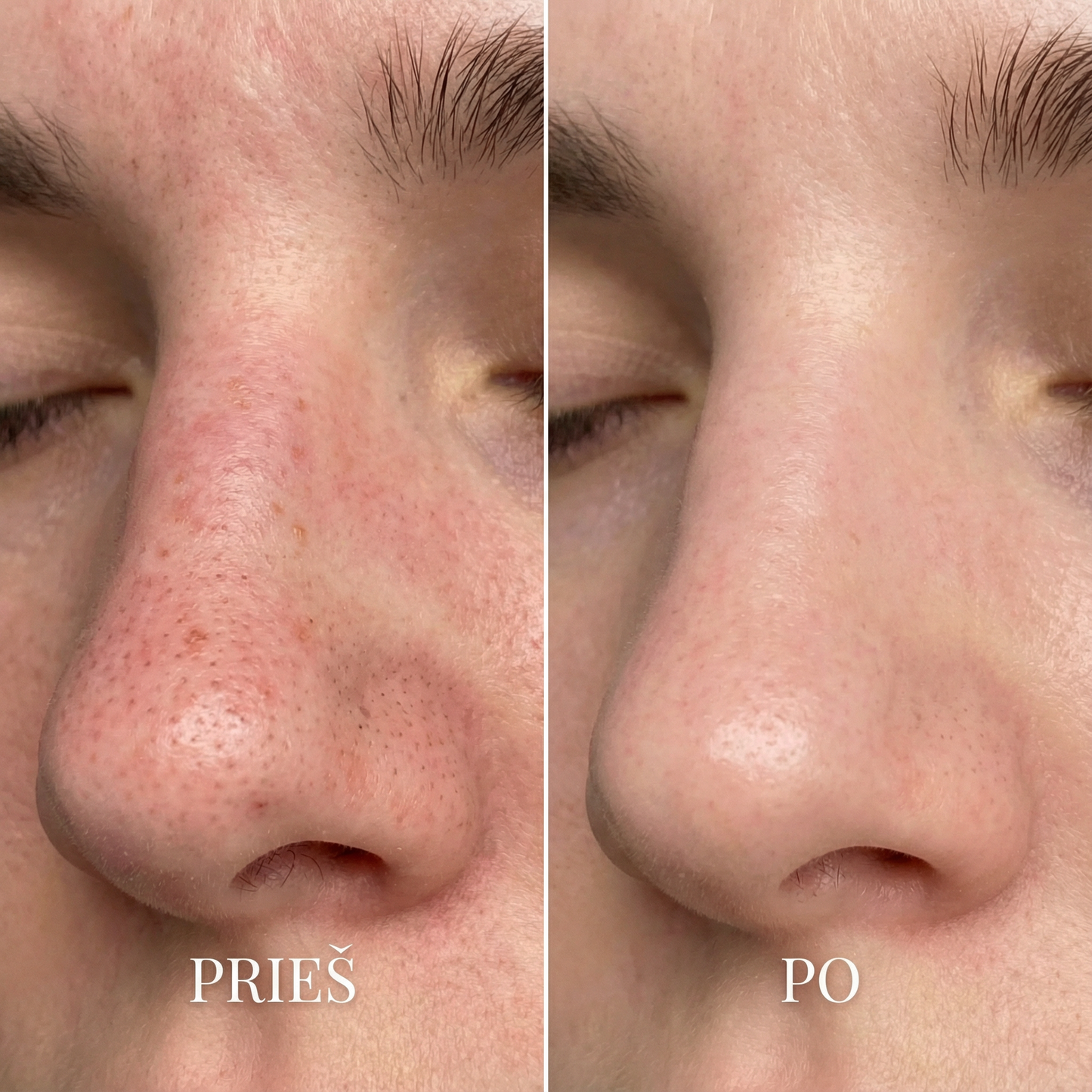 BLIME™ Inkštirų Valymo Įrenginys